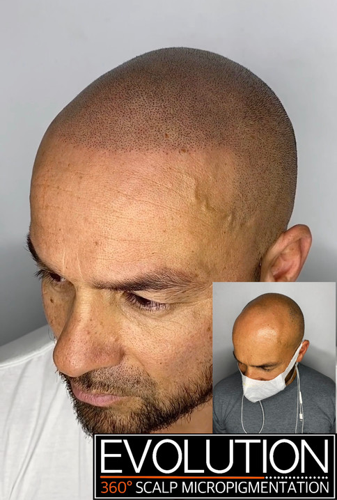SMP result - edged up hairline