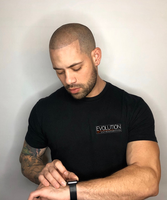 SMP before and after - hairline