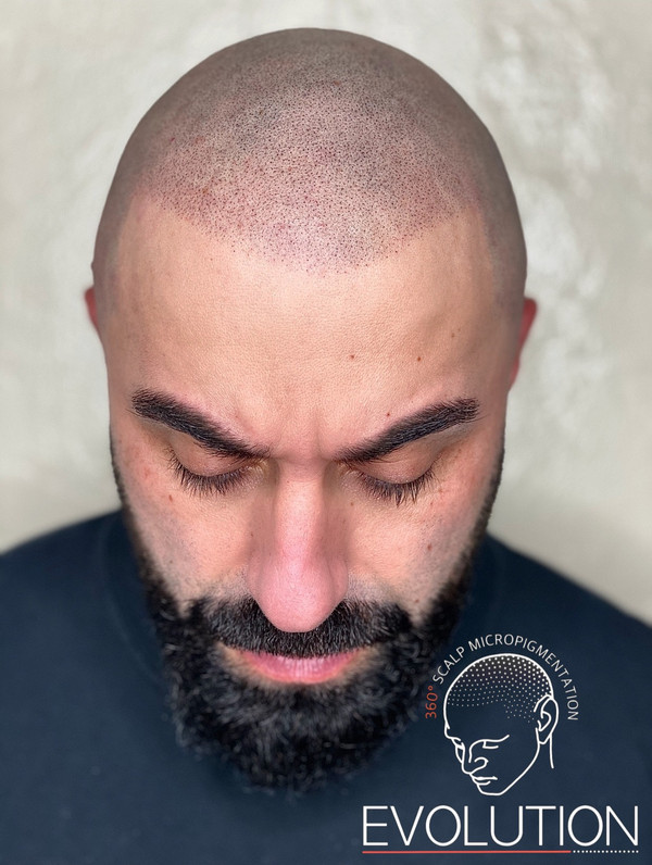 SMP before and after - full head